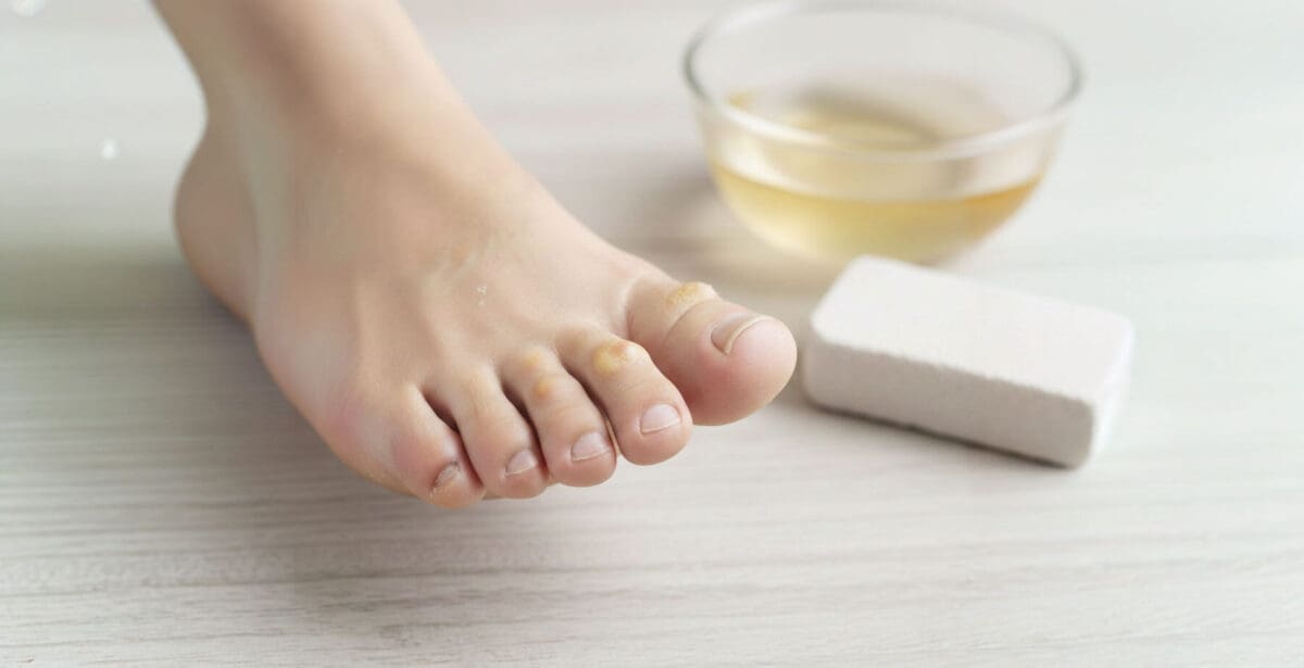 Corns and callus