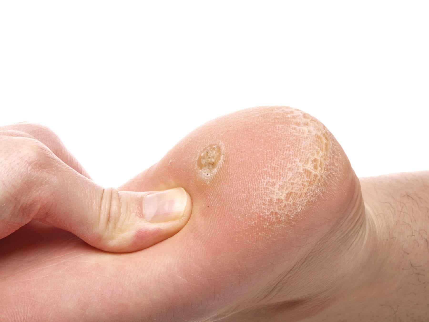 Do plantar warts spread information