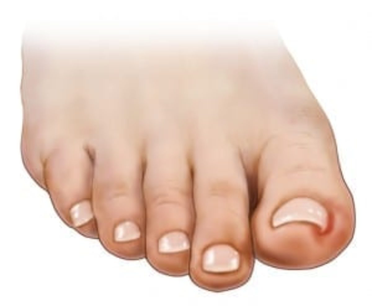 Suffering from an ingrown toenail? | AC Podiatry