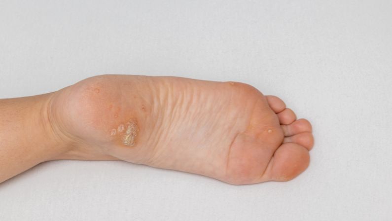 Warts