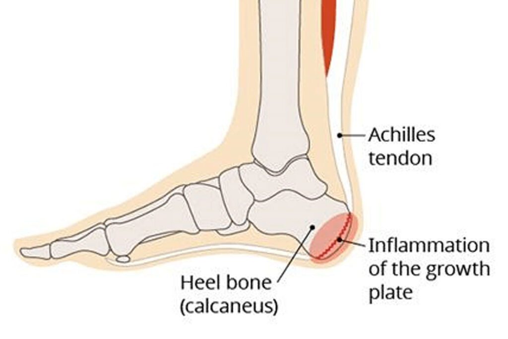 Diagram showing heel bone growth plate inflammation in Sever's disease (calcaneal apophysitis)